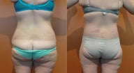 Body Lift 