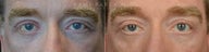 before and after bilateral canthoplasty with release of retractors