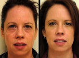 One syringe of Juvederm Ultra XC injected into tear troughs and cheeks