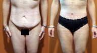 Body Lift 