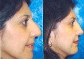 Rhinoplasty