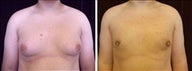 16 year old male, male breast reduction
