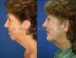 Chin implant after massive weight loss