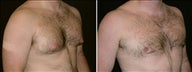 33 year old male, male breast reduction