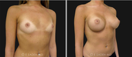 Breast Augmentation