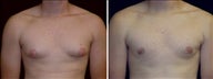 19 year old male, male breast reduction