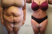 Tummy Tuck