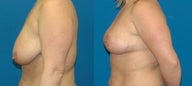 Breast Lift