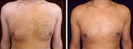 28 year old male, male breast reduction