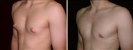 18 year old male, male breast reduction