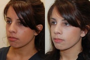 Rhinoplasty Surgery. 2 months post-op