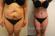 Tummy Tuck