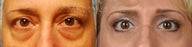 Before and After upper and lower eyelid blepharoplasty