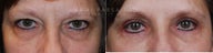 Before and After upper and lower eyelid blepharoplasty with fami endobrow and PCA