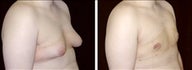 19 year old male, male breast reduction