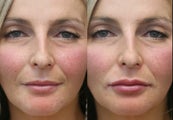 Lip Augmentation