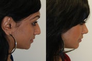 Rhinoplasty Surgery. 6 months post-op.