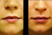 Lip Augmentation