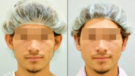 Ear Surgery (Bilateral Otoplasty)