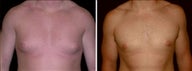 24 year old male, male breast reduction