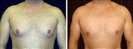 23 year old male, male breast reduction