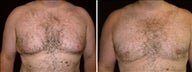 38 year old male, male breast reduction