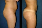 Brazilian Butt Lift