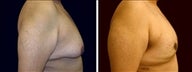 46 year old male, male breast reduction