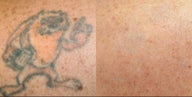 PicoSure Tattoo Removal 