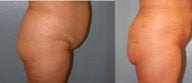 Brazilian butt lift