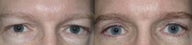 Eyelid Surgery