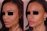 African American Rhinoplasty