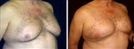 68 year old male, male breast reduction