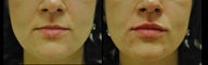 Juvederm for Lip Augmentation