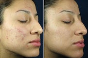 Acne Treatment