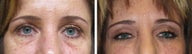 Juvederm/Fat Grafting