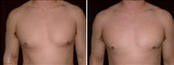 22 year old male, male breast reduction