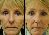Fractional CO2 Laser