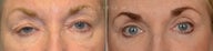 before after bilateral upper lower eyelid blepharoplasty ptosis repair