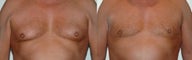 Liposculpture