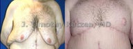 Male Breast Reduction
