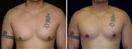 29 year old male, male breast reduction
