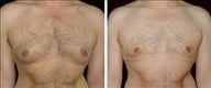 37 year old male, male breast reduction