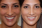 Rhinoplasty