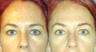 Brow lift