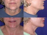 Neck lift