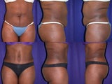 Tummy tuck