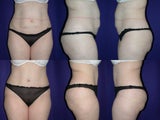 Tummy tuck
