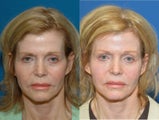 Fat grafting temple and brow