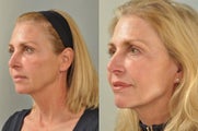 Facelift